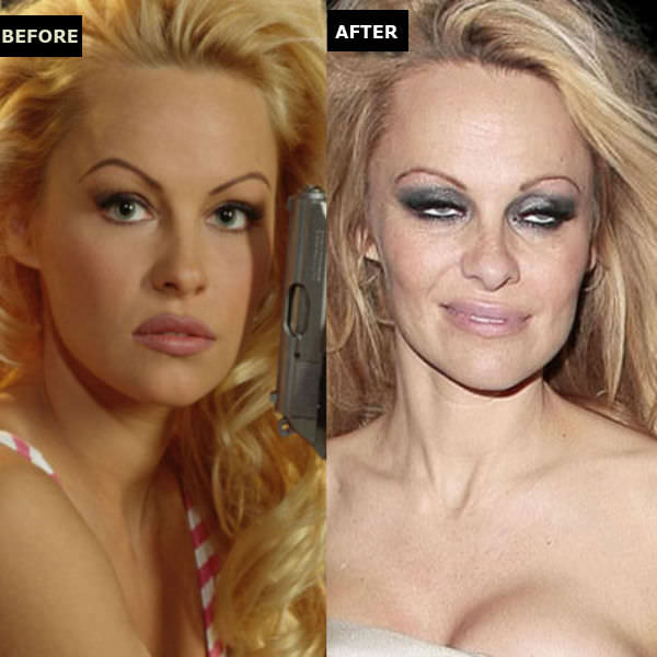 15 Celebrities Ruined Their Lives With Plastic Surgery Powws