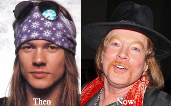 Axl Rose Plastic Surgery Before and After Photos 1